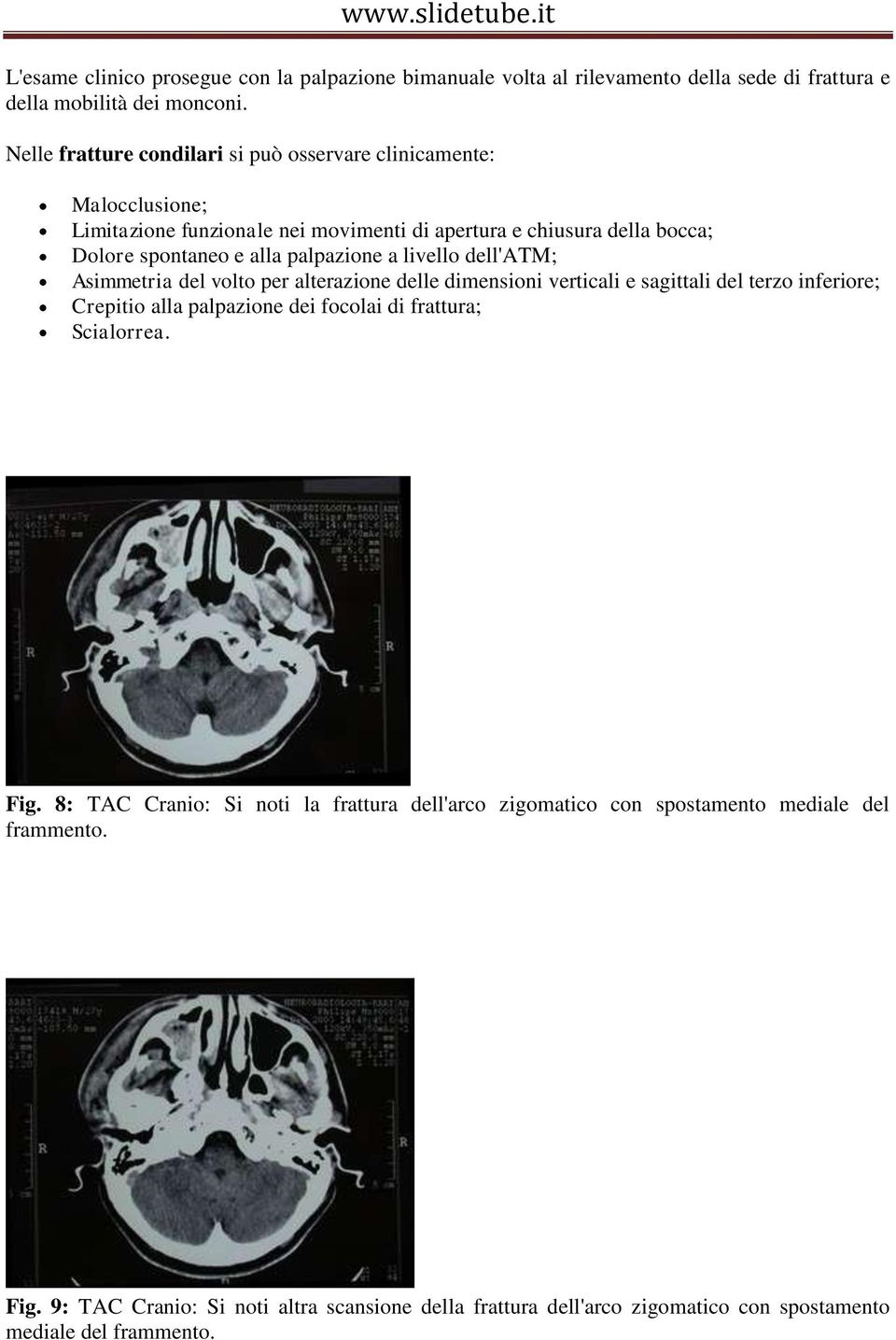 palpazione a livello dell'atm; Asimmetria del volto per alterazione delle dimensioni verticali e sagittali del terzo inferiore; Crepitio alla palpazione dei focolai di