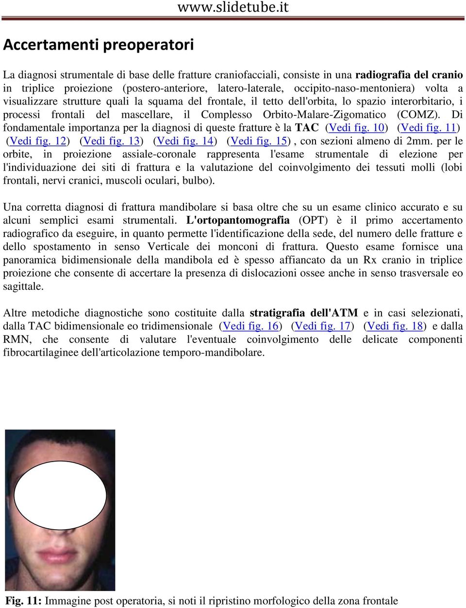 visualizzare strutture quali la squama del frontale, il tetto dell'orbita, lo spazio interorbitario, i processi frontali del mascellare, il Complesso Orbito-Malare-Zigomatico (COMZ).