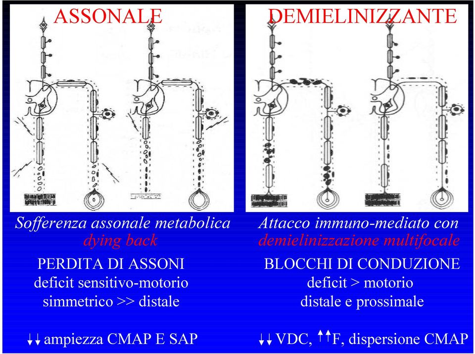 immuno-mediato con demielinizzazione multifocale BLOCCHI DI CONDUZIONE