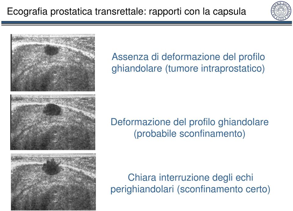 intraprostatico) Deformazione del profilo ghiandolare (probabile