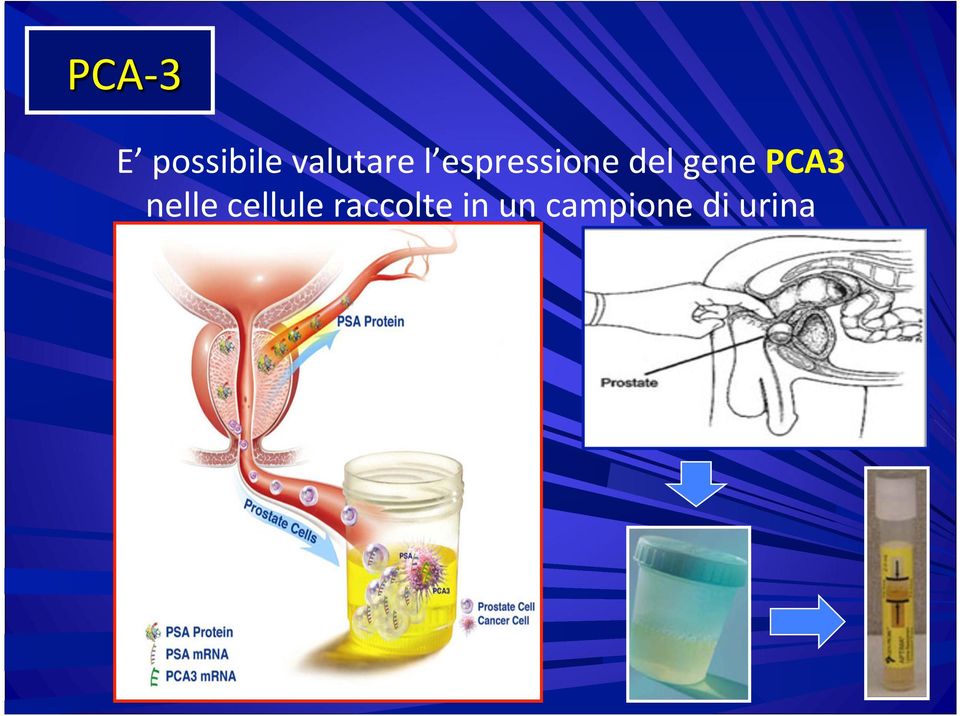 del gene PCA3 nelle