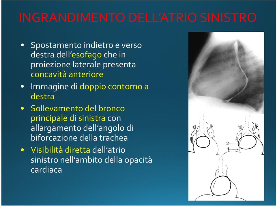 Sollevamento del bronco principale di sinistra con allargamento dell angolo di