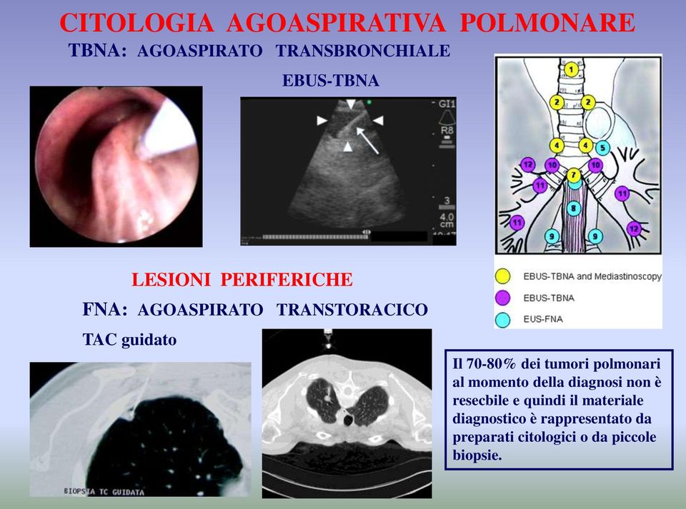 tumori polmonari al momento della diagnosi non è resecbile e quindi il