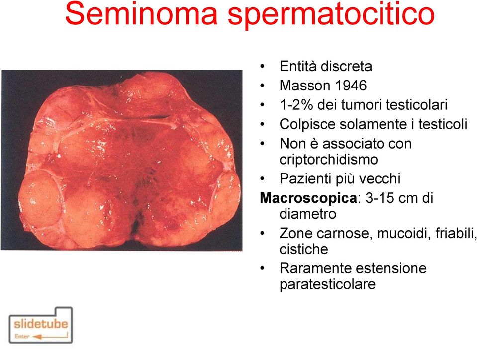 criptorchidismo Pazienti più vecchi Macroscopica: 3-15 cm di diametro