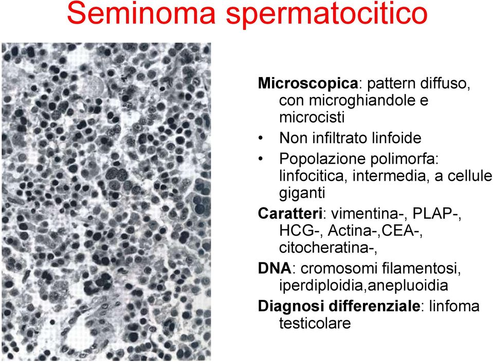 cellule giganti Caratteri: vimentina-, PLAP-, HCG-, Actina-,CEA-, citocheratina-,