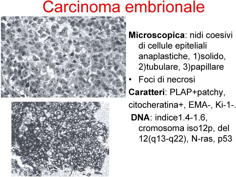 Foci di necrosi Caratteri: PLAP+patchy, citocheratina+, EMA-,