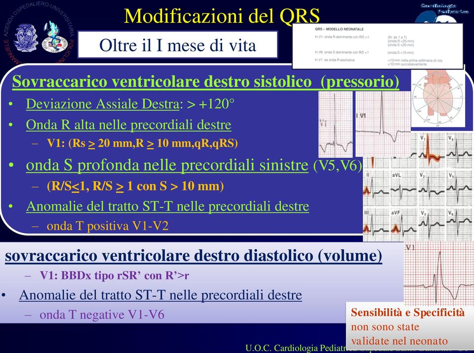 ST-T nelle precordiali destre onda T positiva V1-V2 sovraccarico ventricolare destro diastolico (volume) V1: BBDx tipo rsr con R >r Anomalie del tratto ST-T
