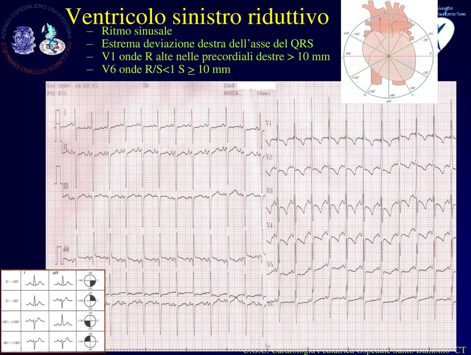 nelle precordiali destre > 10 mm V6 onde R/S<1 S > 10