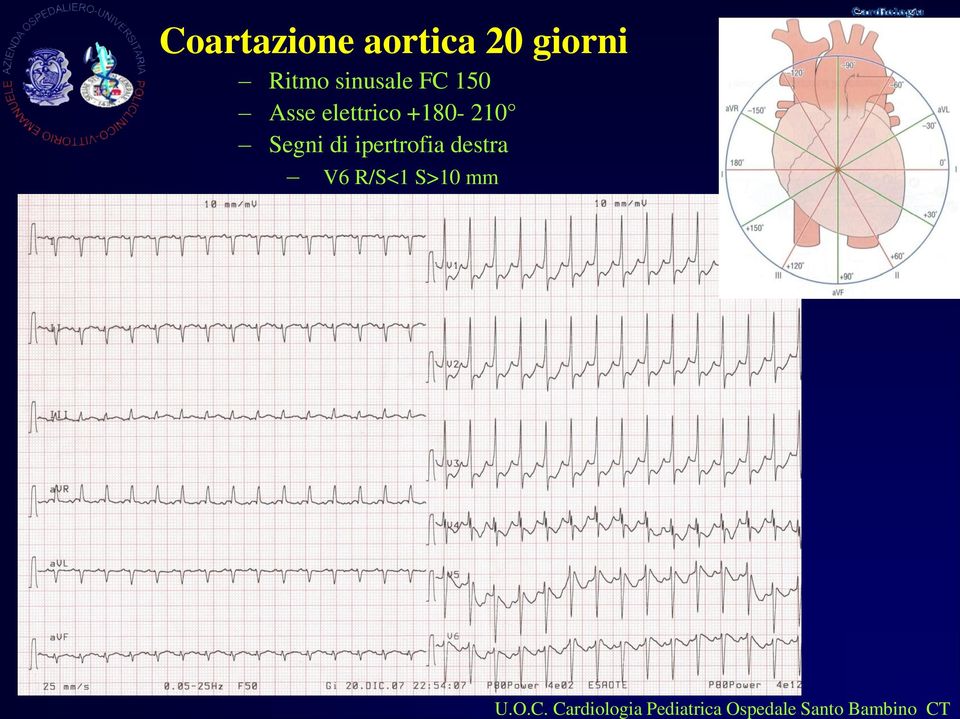 Segni di ipertrofia destra V6 R/S<1 S>10 mm