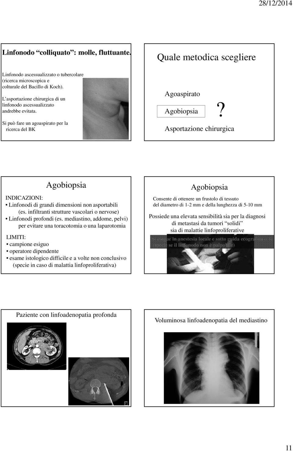 Asportazione chirurgica Agobiopsia INDICAZIONI: Linfonodi di grandi dimensioni non asportabili (es. infiltranti strutture vascolari o nervose) Linfonodi profondi (es.