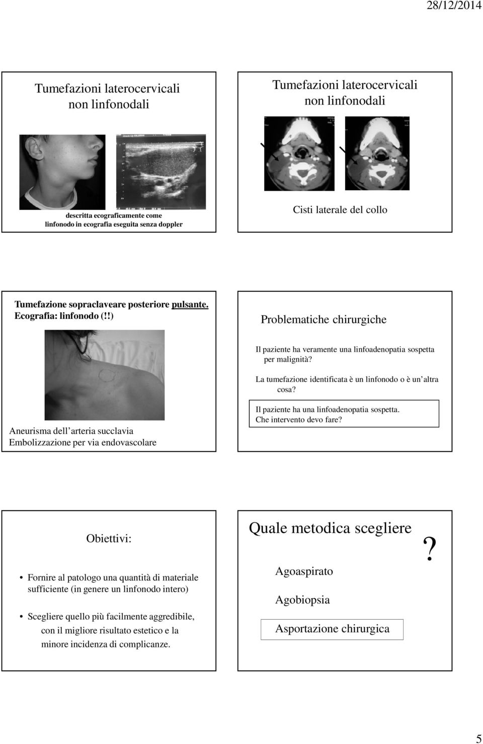 La tumefazione identificata è un linfonodo o è un altra cosa? Aneurisma dell arteria succlavia Embolizzazione per via endovascolare Il paziente ha una linfoadenopatia sospetta.