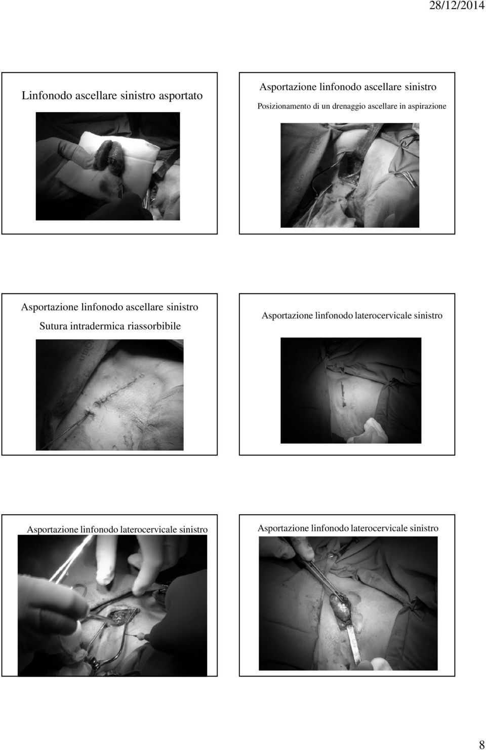 Asportazione linfonodo laterocervicale sinistro Asportazione