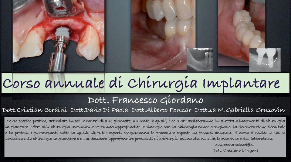 Oltre alla chirurgia implantare verranno approfondite le sinergie con la chirurgia muco gengivale, la rigenerazione tissutale e la protesi.