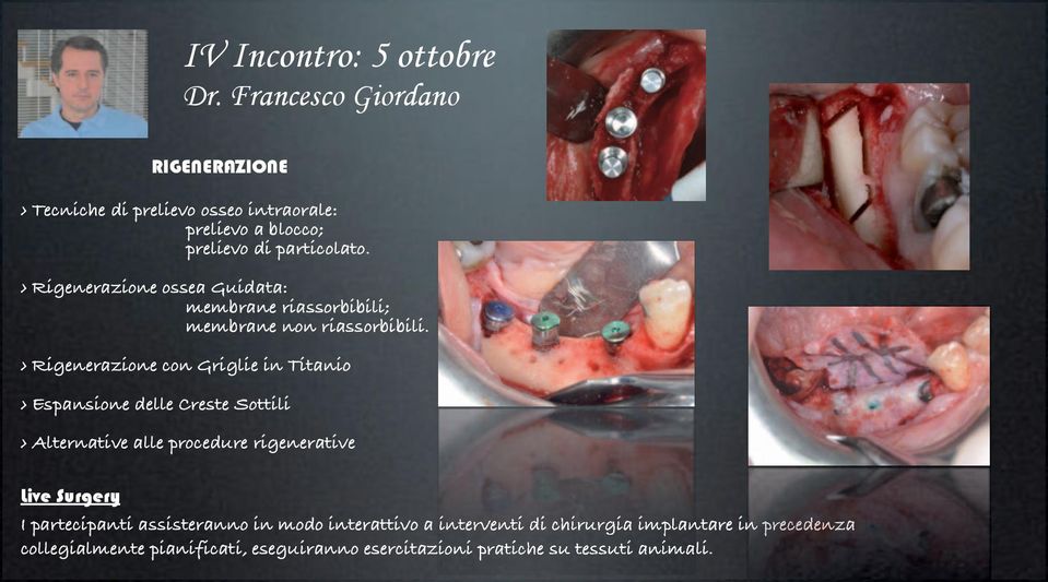 Rigenerazione ossea Guidata: membrane riassorbibili; membrane non riassorbibili.