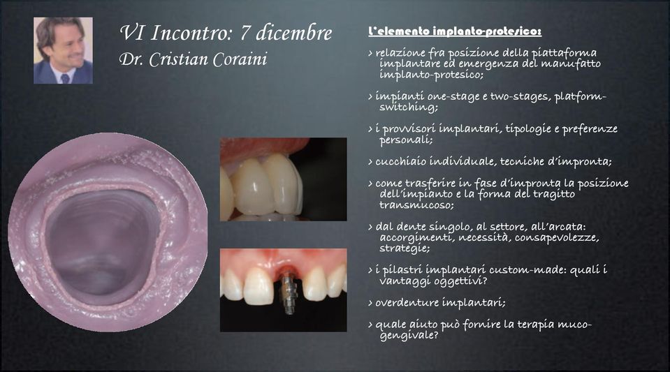 one-stage e two-stages, platformswitching; i provvisori implantari, tipologie e preferenze personali; cucchiaio individuale, tecniche d impronta; come trasferire in