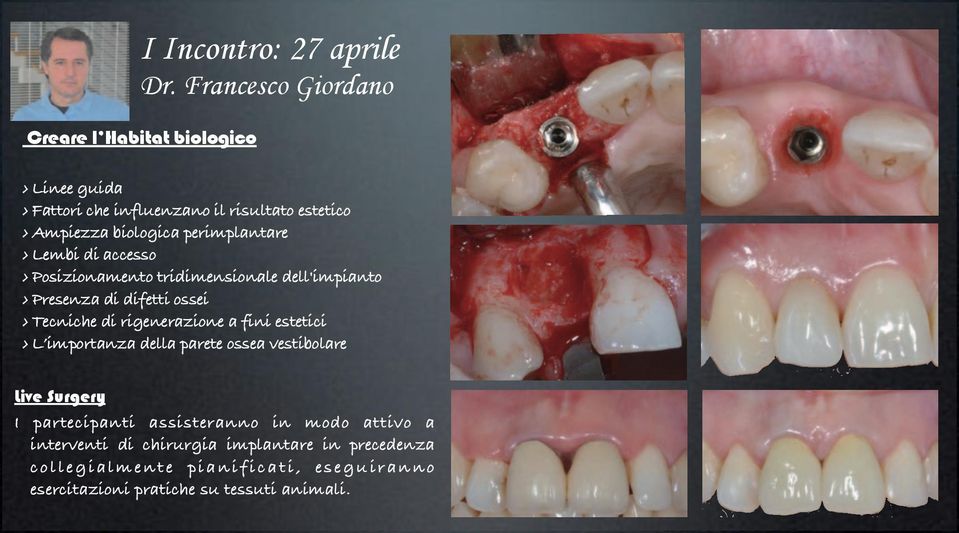 perimplantare Lembi di accesso Posizionamento tridimensionale dell'impianto Presenza di difetti ossei Tecniche di rigenerazione a