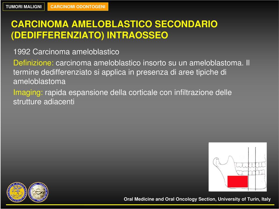 ameloblastoma.