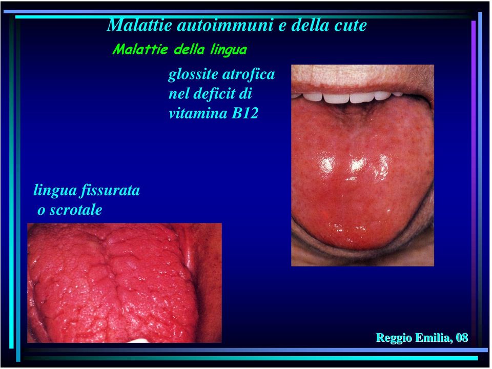 deficit di vitamina B12