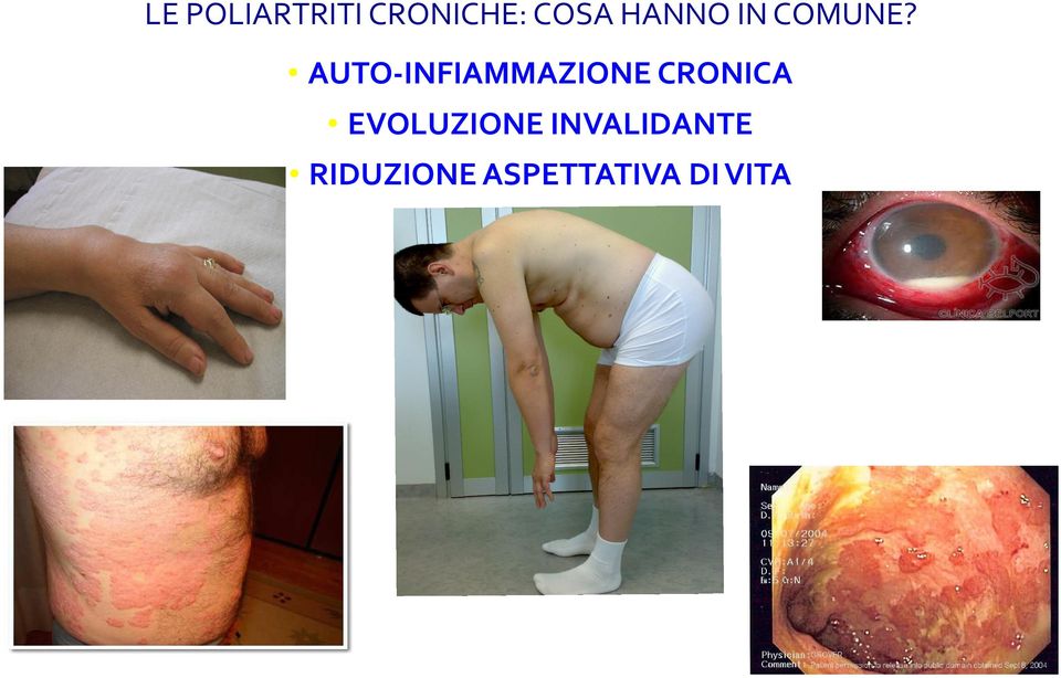 AUTO-INFIAMMAZIONE CRONICA EVOLUZIONE