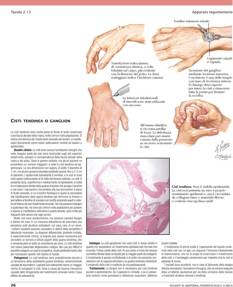 Le cisti sono comuni tumefazioni benigne che nella maggior parte dei casi sono localizzate sugli arti superiori distalmente, perlopiù in corrispondenza della faccia dorsale della mano o del polso.