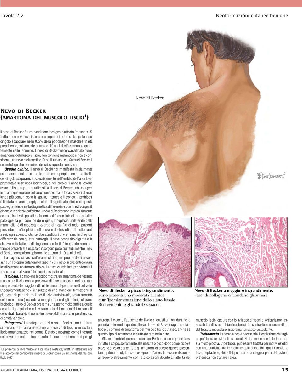 frequentemente nelle femmine. Il nevo di Becker viene classificato come amartoma del muscolo liscio, non contiene melanociti e non è considerato un nevo melanocitico.