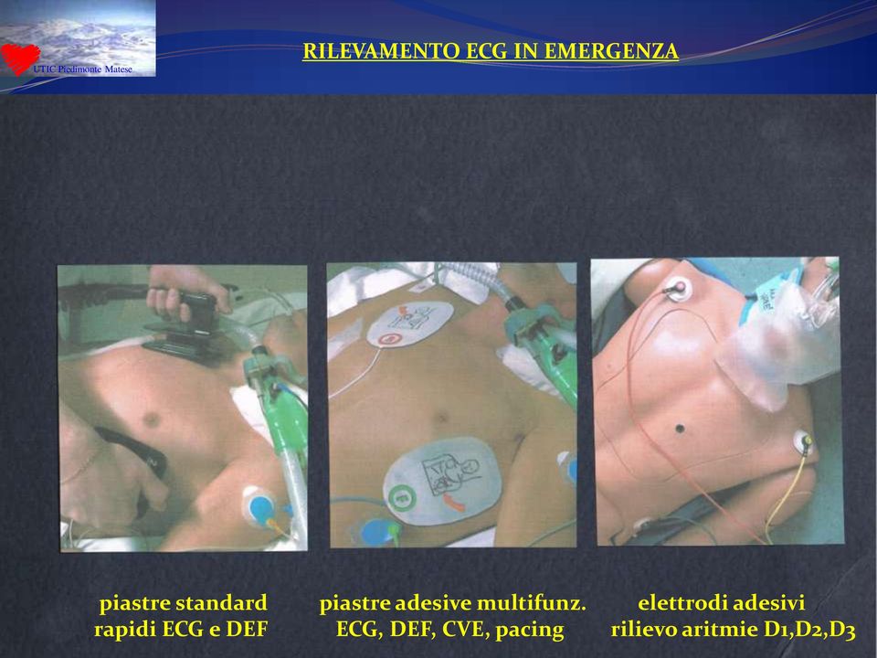 elettrodi adesivi rapidi ECG e DEF