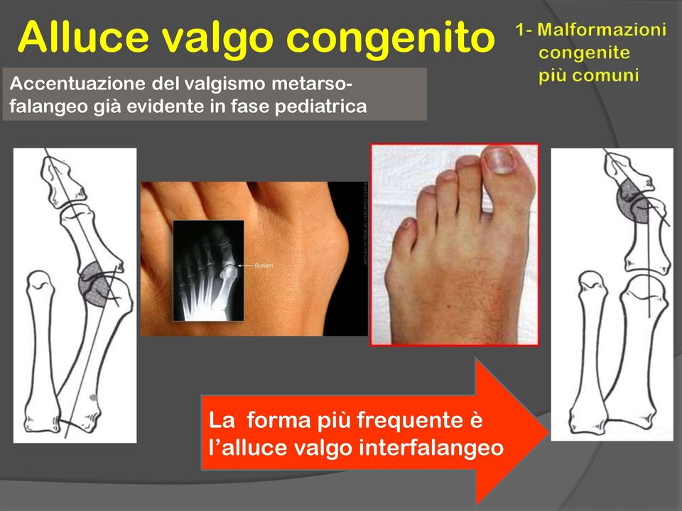 evidente in fase pediatrica La forma