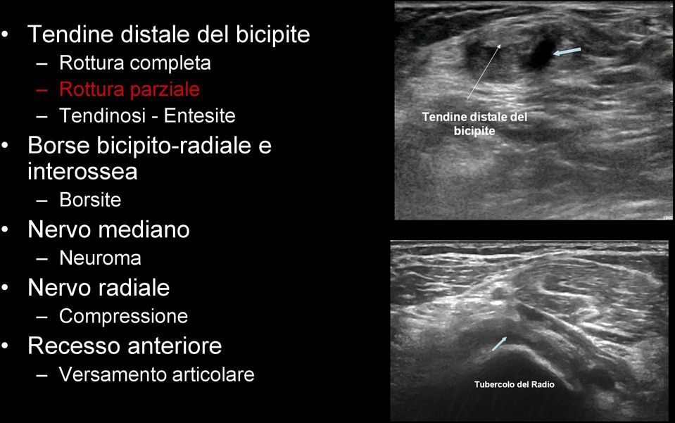 e interossea Borsite Nervo mediano Neuroma Nervo