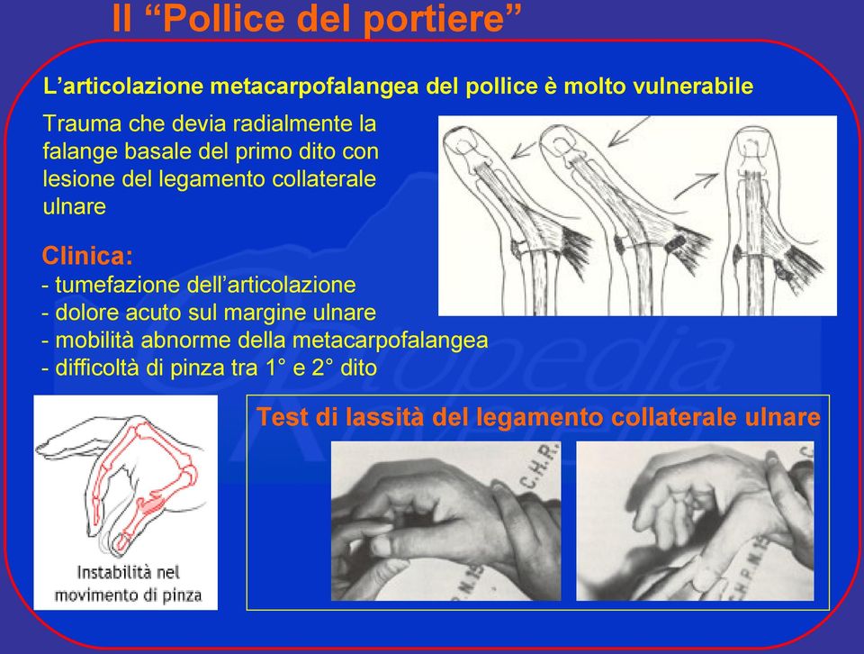 Clinica: - tumefazione dell articolazione - dolore acuto sul margine ulnare - mobilità abnorme della