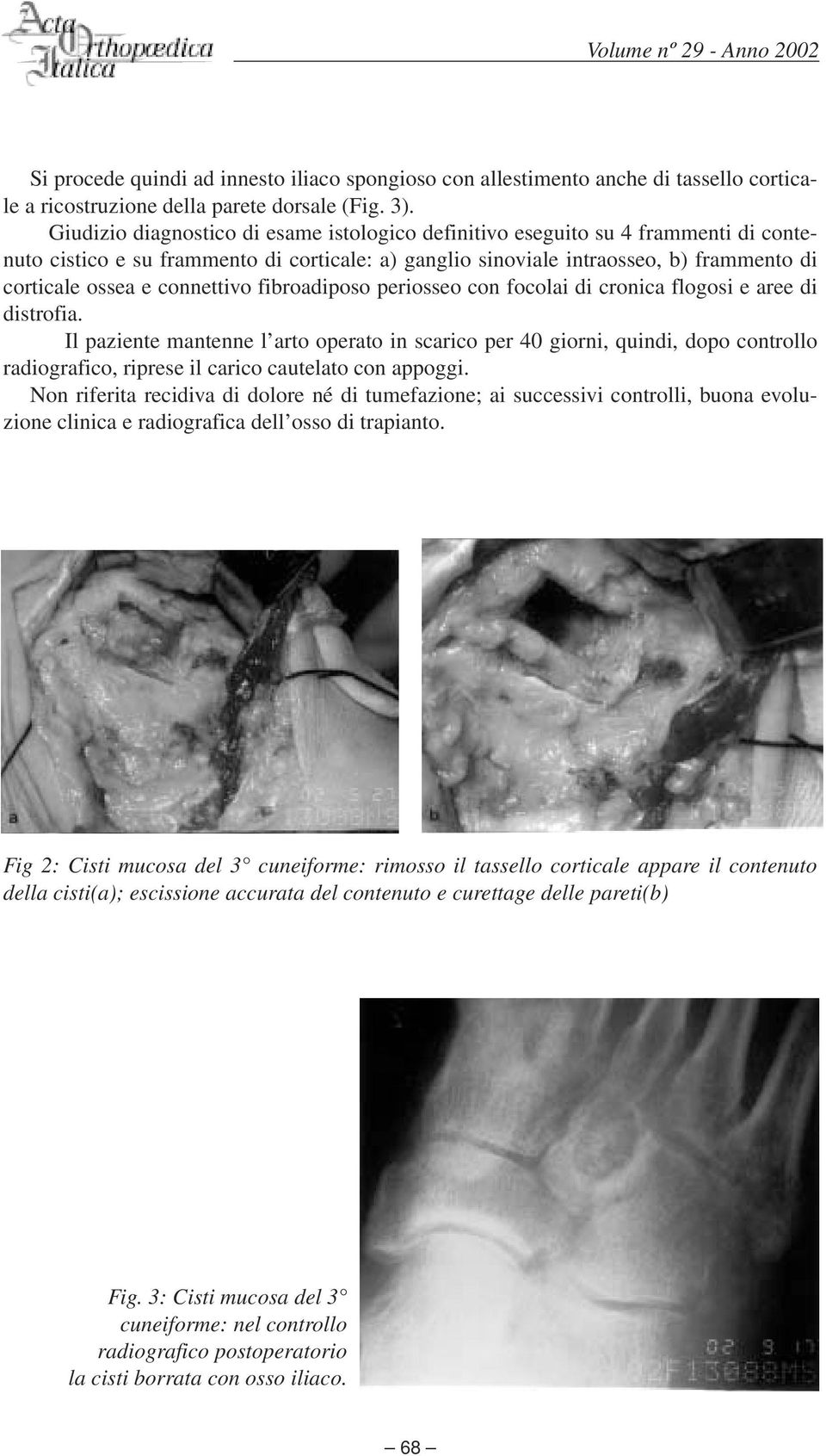 connettivo fibroadiposo periosseo con focolai di cronica flogosi e aree di distrofia.