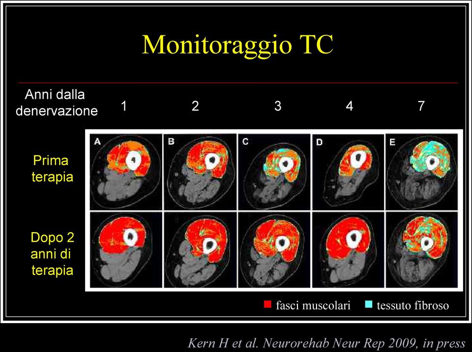 terapia fasci muscolari tessuto fibroso