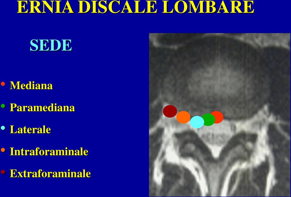 Paramediana Laterale