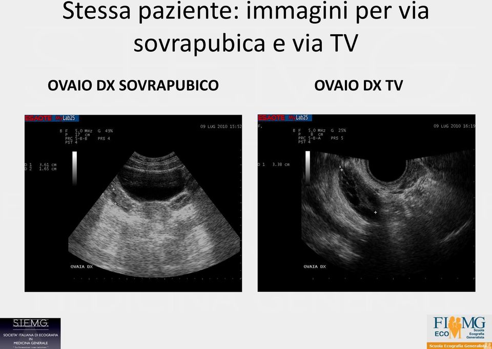 sovrapubica e via TV