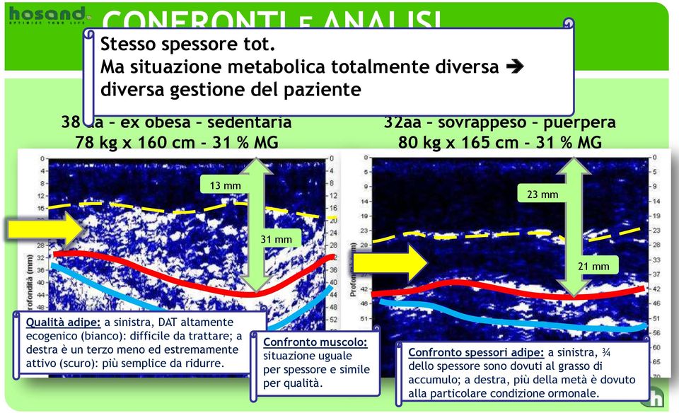 puerpera 80 kg x 165 cm - 31 % MG 13 mm 23 mm 31 mm 21 mm Qualità adipe: a sinistra, DAT altamente ecogenico (bianco): difficile da trattare; a destra è un terzo