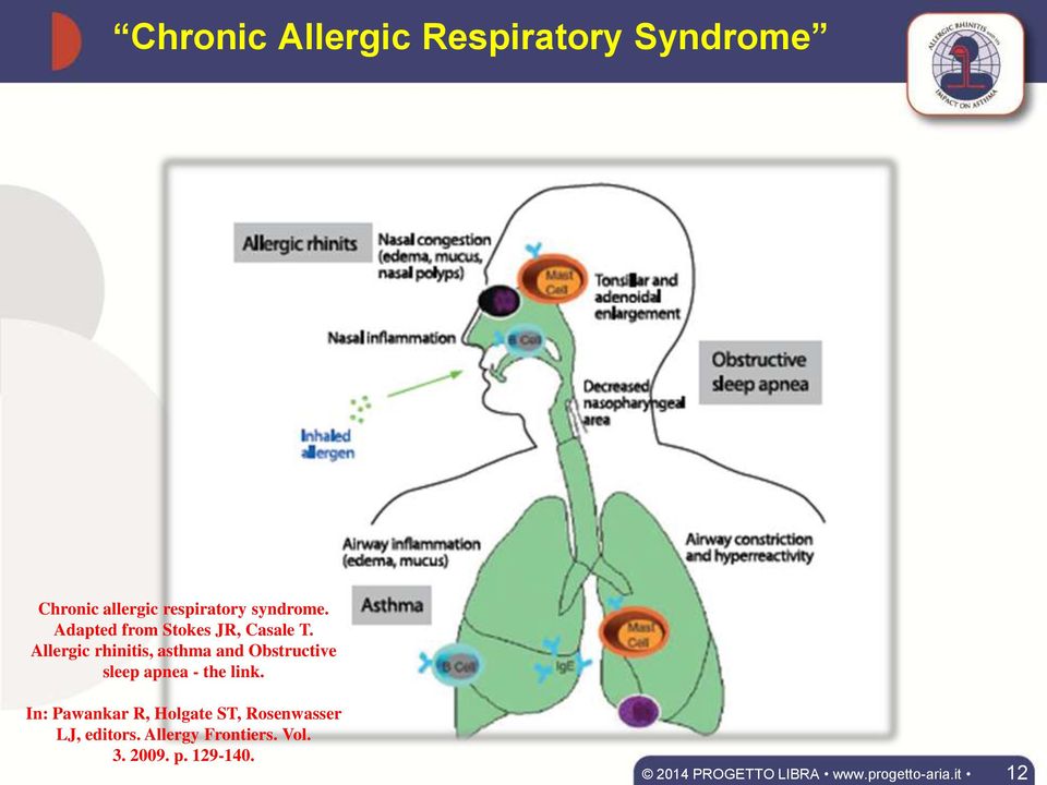 Allergic rhinitis, asthma and Obstructive sleep apnea - the link.