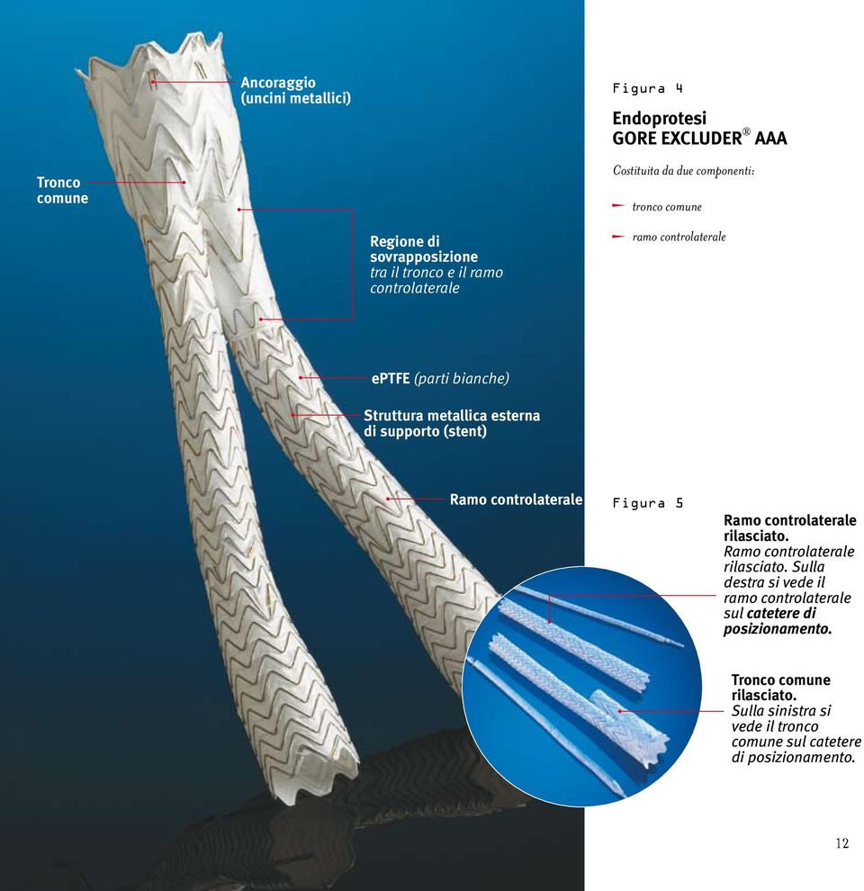 (stent) Ramo controlaterale Figura 5 Ramo controlaterale rilasciato.