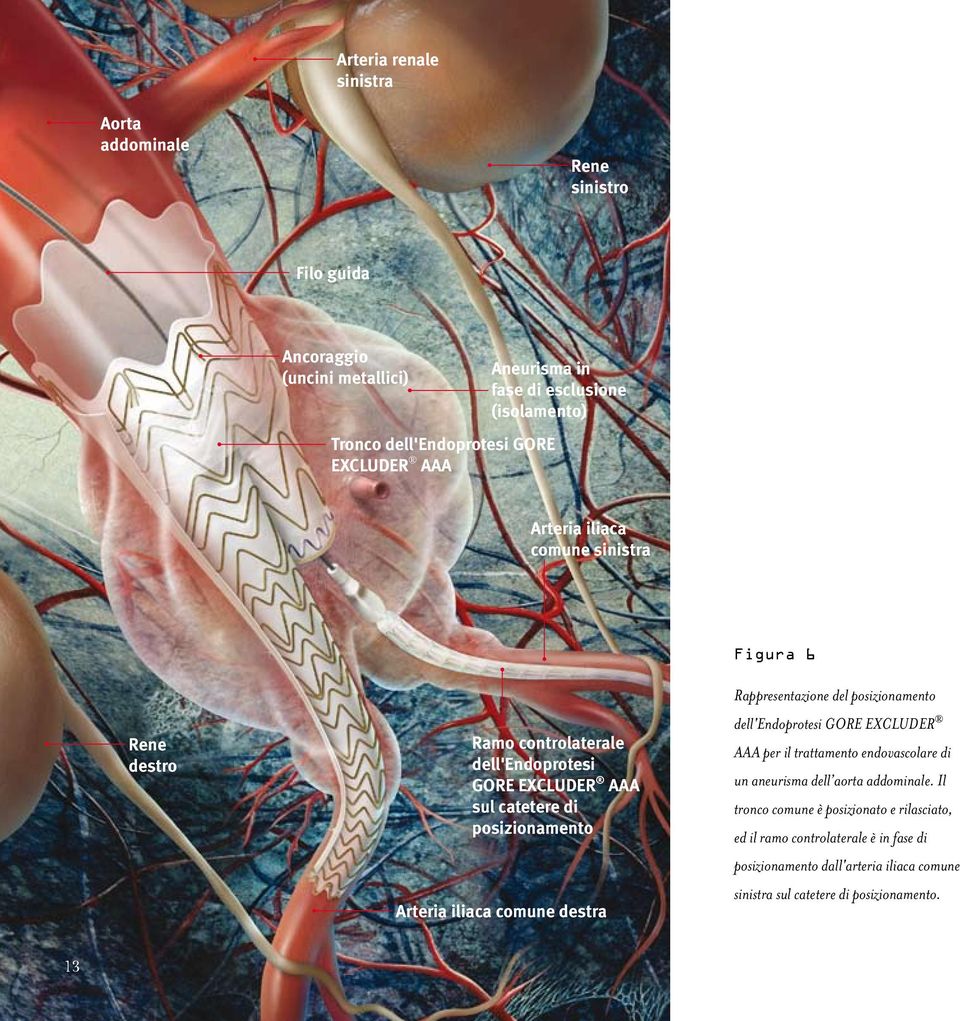 iliaca comune destra Figura 6 Rappresentazione del posizionamento dell'endoprotesi GORE EXCLUDER AAA per il trattamento endovascolare di un aneurisma dell aorta