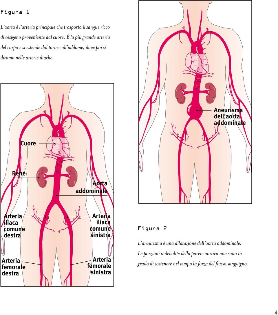 Aneurisma dell'aorta addominale Cuore Rene Aorta addominale Arteria iliaca comune destra Arteria femorale destra Arteria iliaca comune