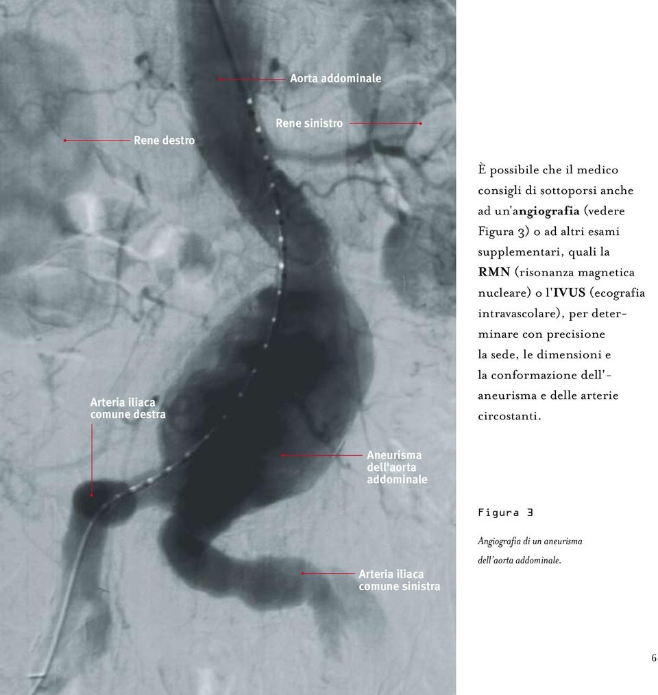 intravascolare), per determinare con precisione la sede, le dimensioni e la conformazione dell'- aneurisma e delle arterie