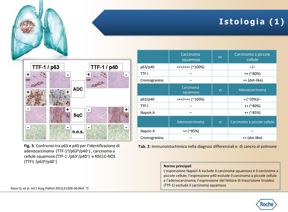3: Confronto tra p63 e p40 per l identificazione di adenocarcinoma (TTF-1 ± /p63 ± /p40 ), carcinoma a cellule squamose (TTF-1 /p63 + /p40 + ) e NSCLC-NOS (TTF1 /p63 ± /p40 ) Rossi G, et al.