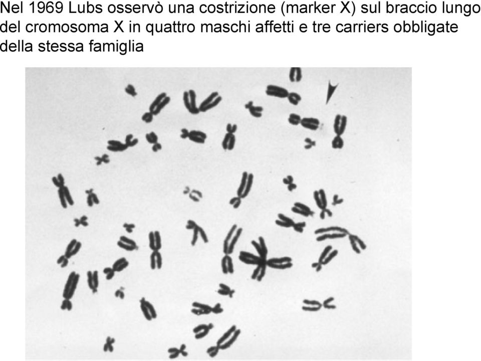 cromosoma X in quattro maschi affetti