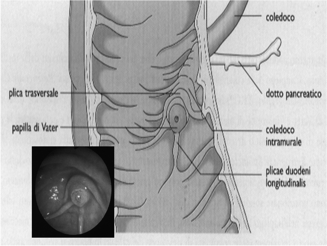 Calcolosi Via Biliare Principale Dal 10 al 15 % di tutti i pazienti che vanno incontro a videolaparocolecistectomia presentano calcoli della VBP: in questi casi l opzione terapeutica è rappresentata