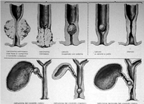 Diagnosi Colelitiasi Segni e sintomi Dolore in ipocondrio destro/epigastrio (spesso postprandiale) irradiato in regione interscapolare spalla destra Nausea Vomito alimentare Massa palpabile Febbre