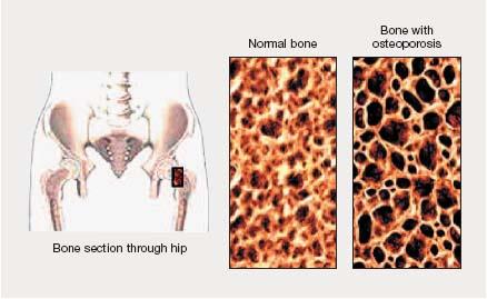 Fisiopatologia dell Osteoporosi Bone remodeling in