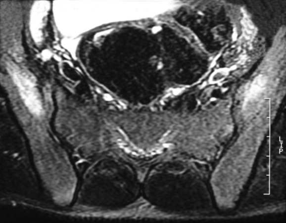 della rima articolare, sclerosi (focale) della corticale su entrambi i versanti dell articolazione con o senza erosione o fusione.