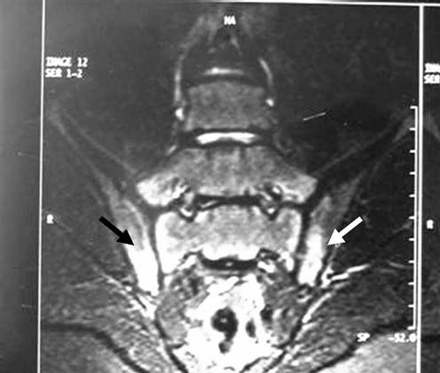 FMF e SACROILEITE spondiloartriti sieronegative (HLA-B27 neg) associate a mutazione M694V Da casi asintomatici con reperti alterati all