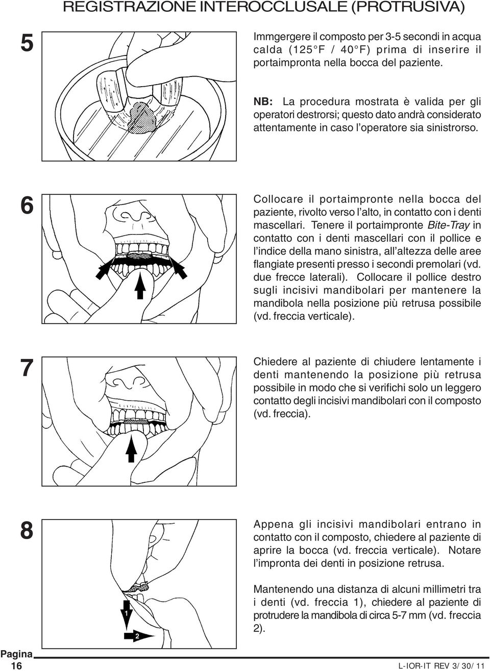 6 7 Collocare il portaimpronte nella bocca del paziente, rivolto verso l alto, in contatto con i denti mascellari.