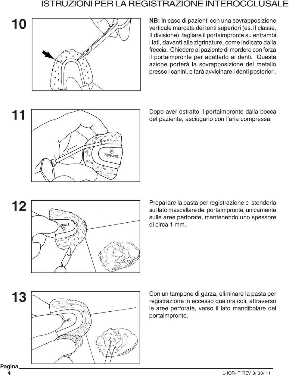 Chiedere al paziente di mordere con forza il portaimpronte per adattarlo ai denti. Questa azione porterà la sovrapposizione del metallo presso i canini, e farà avvicinare i denti posteriori.