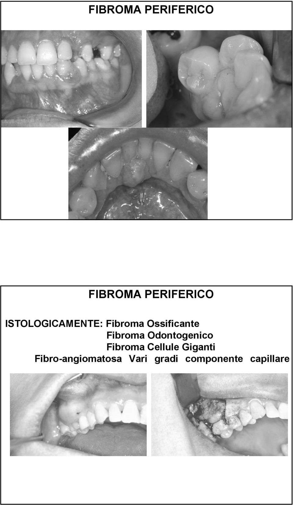 Fibroma Odontogenico Fibroma Cellule