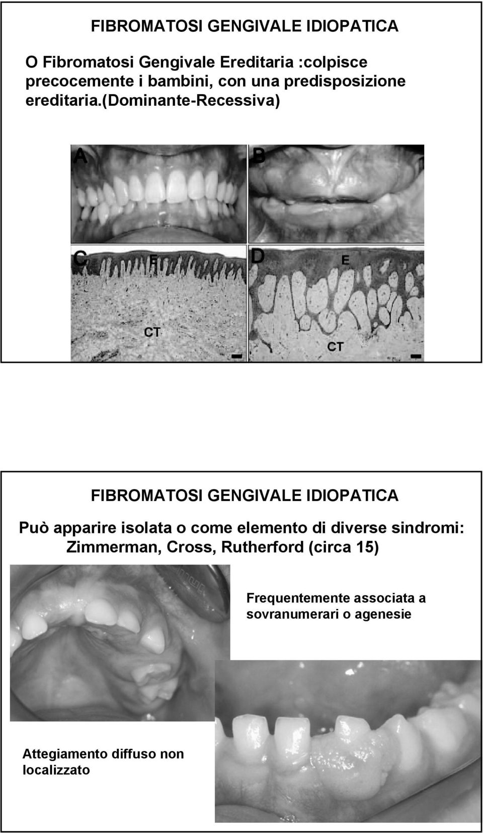 (dominante Dominante-Recessiva) FIBROMATOSI GENGIVALE IDIOPATICA Può apparire isolata o come